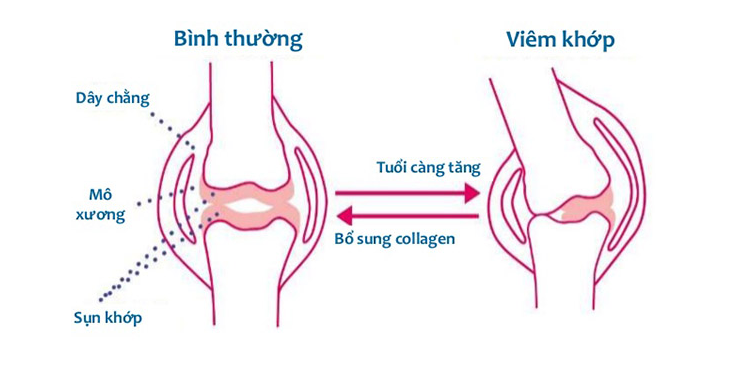 Collagen type 2 và tác dụng tuyệt vời đối với bệnh thoái hóa khớp